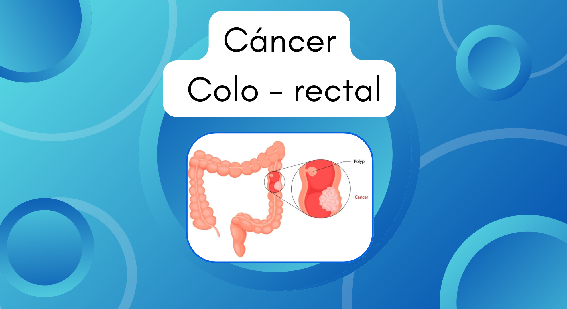 Cáncer Colo-rectal